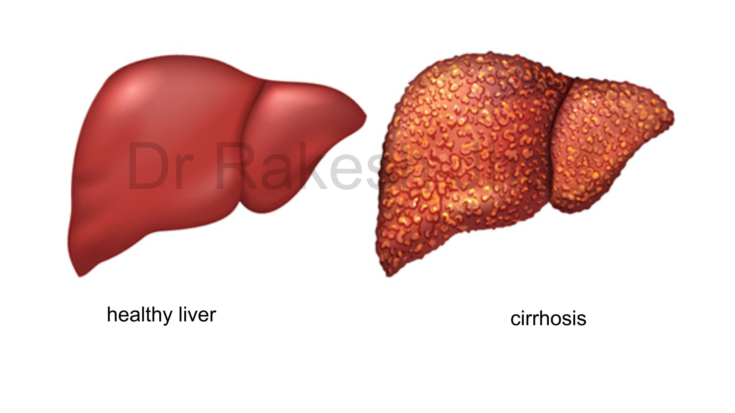 लिवर सिरोसिस – लक्षण, कारण, रोकथाम एवं उपचार